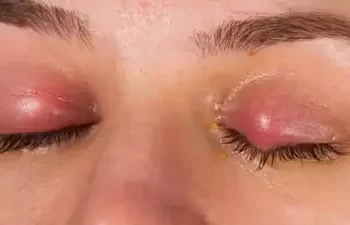 ਆਈਫਲੂ ਉੱਪਰ ਸੈਮੀਨਾਰ ਅਤੇ ਹੈਲਥ ਚੈੱਕਅਪ ਕੈਂਪ